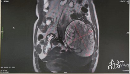 三分之二的肝被切除，他却感叹：像卸下了一块大石头