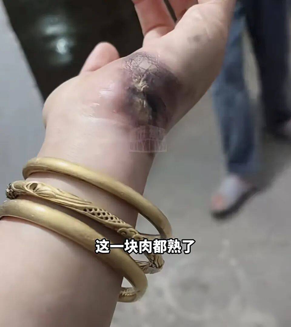 一瞬间手被烧熟,金手镯被电碎!女子给电动车充电,不慎碰到充电口受伤